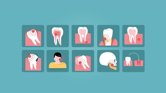 Weisheitszähne eignen sich gut, um fehlende Zähne zu ersetzen und die natürliche Zahnreihe wiederherzustellen. Foto: proDente e.