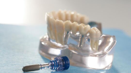 Bei einem klassischen Zahnimplantat vergehen hingegen mehrere Wochen oder Monate zwischen dem Entfernen des Zahns und dem Einset